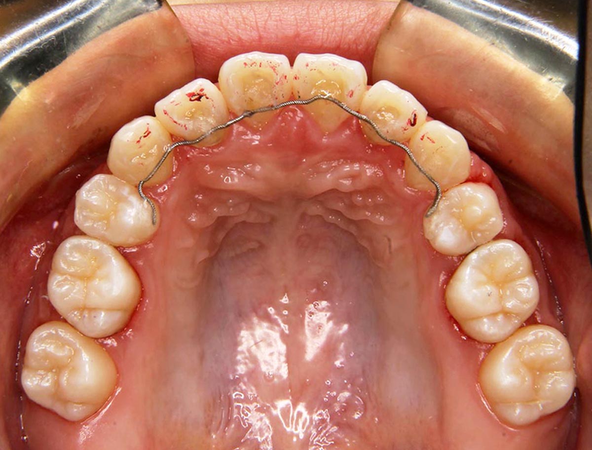 上顎前突 出っ歯 犬歯埋伏症例 19年2月13日 最新の治療例 アップル歯列矯正歯科 自由が丘